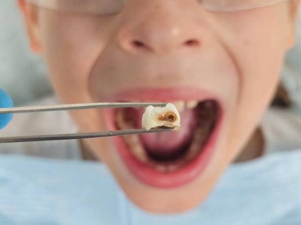 Best Knocked-Out Tooth (Avulsed Tooth) Treatment in Crescent City, CA